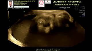 Celah bibir  Hipospadia  Dilatasi usus  Atresia ani 37 weeks [upl. by Kcorb]