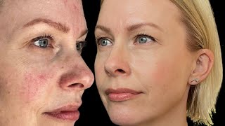 HOW I FIXED my rosacea ‼ [upl. by Demona705]