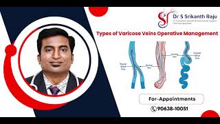 Varicose Veins Operative Management Types  DrSrikanth Raju  Vascular Surgeon  Hyderabad [upl. by Gean]