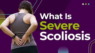 What Is Severe Scoliosis [upl. by Haniraz782]