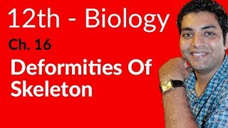 12th Class Biology  Deformities of skeleton  Ch 16  FSc Biology Book 2 [upl. by Marianne]