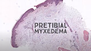 Pretibial myxedema Graves disease thyroid dermopathy pathology dermpath dermatology USMLE [upl. by Osy]