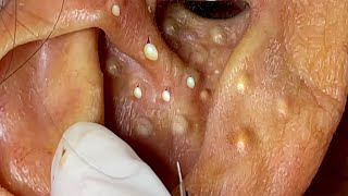 Big Cystic Acne Blackheads Extraction Blackheads amp Milia Whiteheads Removal Pimple Popping  6660 [upl. by Ynobe736]