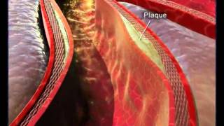 Atherosclerosis Heart disease [upl. by Anerys]