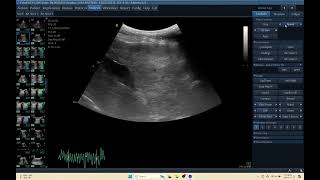 IQ 155 LIVER HEPATOMA ULTRASOUND ECHOPAC ECHOCARDIOGRAPHY HEPATOMA C1 5 RS PROBE [upl. by Berkow837]