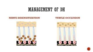 Dentinal Hypersensitivity [upl. by Ahseela]