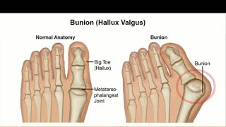 Hallux Valgus Treatment  Cure Hallux Valgus Bunion with Physiotherapy Exercises [upl. by Happy]