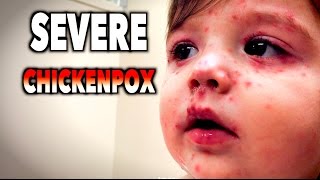 SEVERE CHICKENPOX  Dr Paul [upl. by Tteltrab]