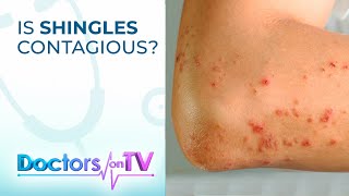 Shingles Cause Symptoms amp Prevention  DOTV [upl. by Anikram]