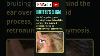 Battles Sign Retroauricular Ecchymosis [upl. by Sturges662]