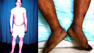 Myxedema Coma in 3 minutes Symptoms Causes Signs [upl. by Leasi210]