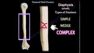 Humeral Shaft Fracture  Everything You Need To Know  Dr Nabil Ebraheim [upl. by Roede]