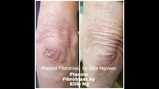 Plasma Fibroblast by Ellie Nguyen [upl. by Dickey987]