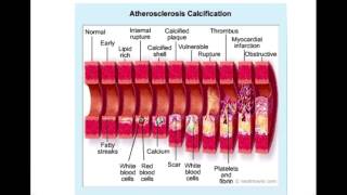 CTCAG Part 4 positive coronary artery remodeling [upl. by Adidnere653]