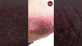 Psoriasis  Types Symptoms amp Causes  Dr Uzma Hameed  Skin Problem  Masala Health [upl. by Atiuqehc]