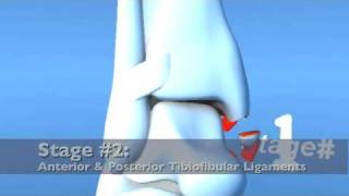 Lauge Hansen PAB Pronation ABduction Eversion Ankle Fracture [upl. by Candice]