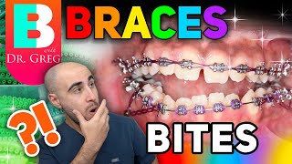 Braces Overbite Overjet Underbite Crossbite amp Open Bite Explained [upl. by Oneladgam74]