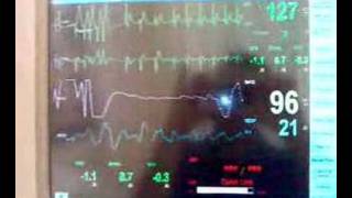 Chemical cardioversion of SVT [upl. by Mcintyre]