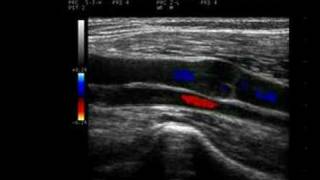 Phlebology Biosound Esaote MyLab 25 Venous Duplex [upl. by Pearlman963]