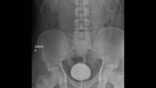 CASE 395 intravenous pyelography IVP left renal agenesis [upl. by Cassandre]