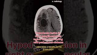 NEOPLASTIC ETIOLOGY CT BRAIN [upl. by Mossberg105]