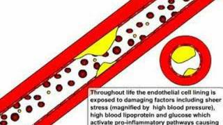 Atherosclerosis and Ischaemic Stroke [upl. by Aeikan]