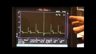 Secondary Ignition Waveforms common faults [upl. by Im443]