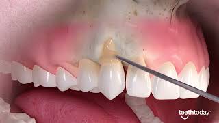 Mastering Gum Recession Treatment Advance Dental Implant and TMJ Center [upl. by Nim89]