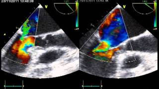 ACUTE PULMONARY OEDEMA due to ECLIPSED FUNCTIONNAL MITRAL REGURGITATION ECHOCARDIOGRAPHY [upl. by Aneer]