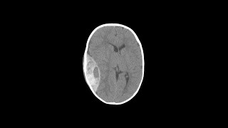 Types of Brain Herniations  Shorts [upl. by Akenahc162]