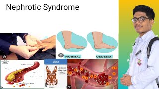 Nephrotic Syndrome  Signs and Symptoms of Nephrotic Syndrome [upl. by Aitnis]