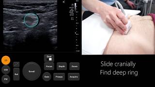 Ultrasound Tutorial InguinalFemoral Hernia Assessment  Radiology Nation [upl. by Innad]