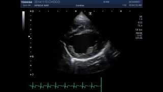 pulmonic stenosis of dog 강아지 폐동맥협착 shortaxis view [upl. by Obrien903]