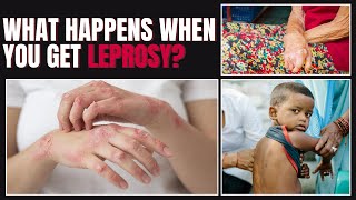 Leprosy Symptoms Types and Whos at Risk Everything You Need to Know [upl. by Flavia762]