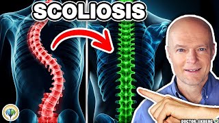 Scoliosis Treatment Without Surgery Or A Brace Scoliosis Pain Relief [upl. by Boesch801]