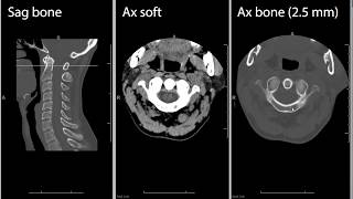 Cervical spine CT computed tomography radiology search pattern [upl. by Arakahs]