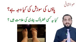 paon ki sujan ka ilaj in urdu  swelling on foot  پاؤں کی سوجن کا علاج [upl. by Dom]