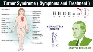 Turner Syndrome  monosomic disorder  symptoms and treatment of turner syndrome in Hindi [upl. by Nahama]