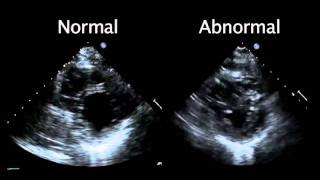 Echocardiogram from the Patient Compared with That from a Normal Control  NEJM [upl. by Gamaliel]