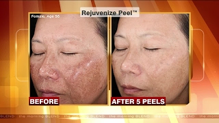 The Benefits of a Chemical Peel [upl. by Keheley141]