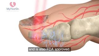 Lunula Laser Treatment with My FootDr Singapore  English subtitles [upl. by Kasper]