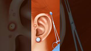 ASMR ear piercing removal Treatment clean ear piercing amp pus 2d animation [upl. by Mika113]