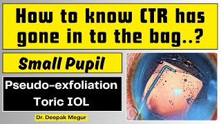 Phaco and Toric IOL in an eye with Pseudoexfoliation and Dense Cataract Dr Deepak Megur [upl. by Irrahs]