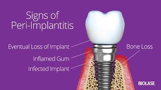 Surgical Regenerative Treatment of PeriImplantitis with TiBrush [upl. by Nelluc586]