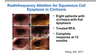 Progress in the Treatment of Squamous Esophageal Dysplasia and EarlyStage Cancer [upl. by Prichard]