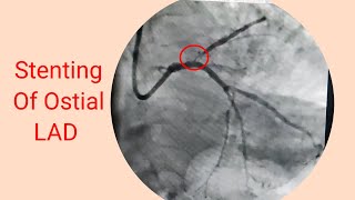 Heart attack AWMI lI Stenting of Ostial LAD [upl. by Dario]