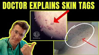 Doctor explains SKIN TAGS  including CLINICAL PHOTOS CAUSES amp TREATMENT [upl. by Annuaerb]