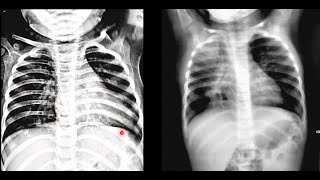 Paediatric Chest Imaging Case discussions [upl. by Letnuhs]