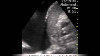 VSCAN Constrictive pericarditis Pocket Ultrasound Pericarditis constrictiva ECO DE BOLSILLO [upl. by Anayhd686]