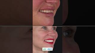 Patient review of veneer placement and dental implants at Dr Tahir Mehmed Tahir Clinic [upl. by Franciskus]